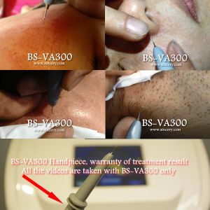 High Frequency Professional Vascular Removal Machine Spider Vein Removal Machine