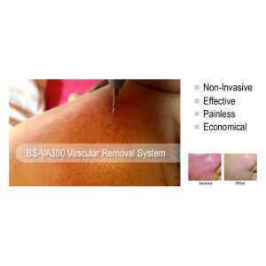 High Frequency Professional Vascular Removal Machine Spider Vein Removal Machine