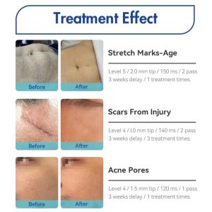 2023 New Multifunction Radio Frequency Micro Needling Rf Microneedling Machine