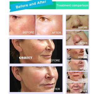 Endolift Laser Lipolysis Machine 1470nm 980nm Varicose Vein Removal Machine