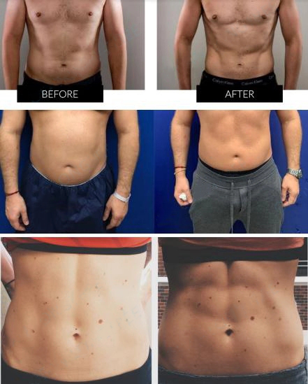 High Intensity Focused Electromagnetic Emslim Fat Burning Machine 3000W