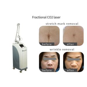 Pixel CO2 Vaginal Rejuvenation Machine , Laser Skin Treatment Equipment
