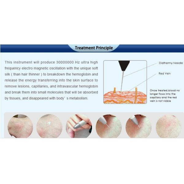Professional High-frequency Vascular Removal Beauty Machine laser spider vein removal with CE approval