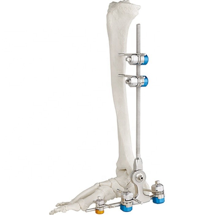 Quality Medical Bone Hammer External Fixation Device Ankle Fracture for sale