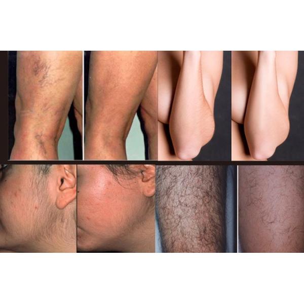 Fast Painless Diodo Laser Machine Hair Removal CE FDA Certificate