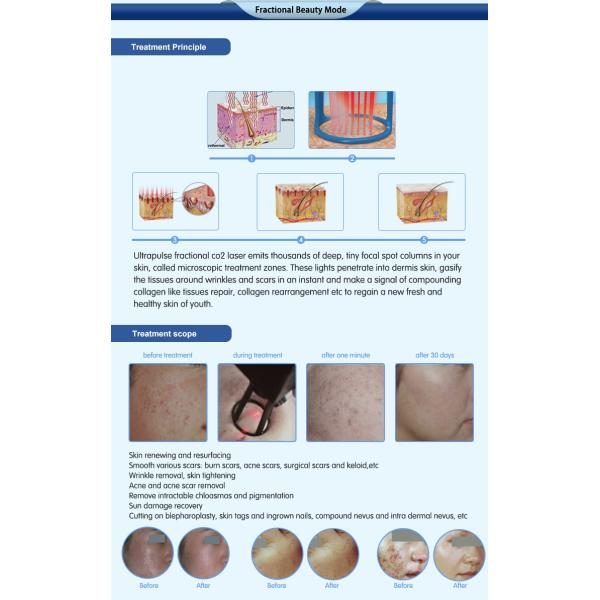 2016 laser equipment vaginal rejuvenation skin rejuvenation medical surgical 10600nm fractional co2 laser system machine