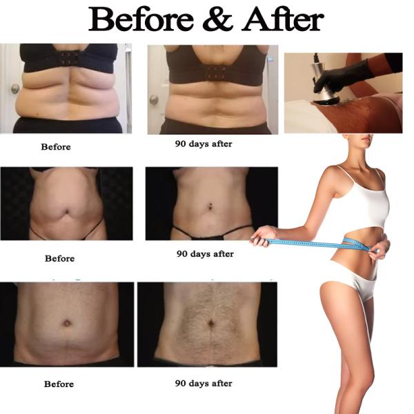 AURO Vacuum Cavitation Slimming Machine 5 In 1 RF 40K For Weight Loss