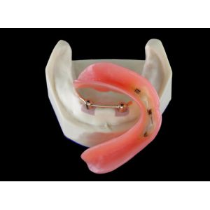All-On-4 Titanium CNC Implant Secured Dentures For Dental Clinic