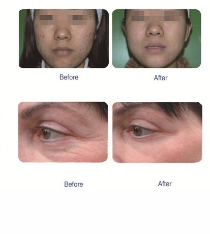 Water Oxygen / Microdermabrasion 3 In 1 E-Light IPL RF Machine MED-370+