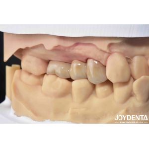 High Biocompatibility Zirconia Full Contour Crown Perfect Fit High Strength