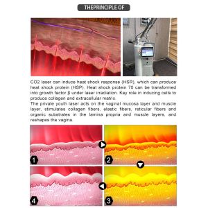 Hot Selling Wholesale CO2 Fractional Laser Equipment +vaginal laser+ cutting