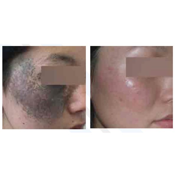 Q Switched Nd YAG Laser Tattoo Removal Machine , Laser Treatment For Birthmark / Nail Fungus