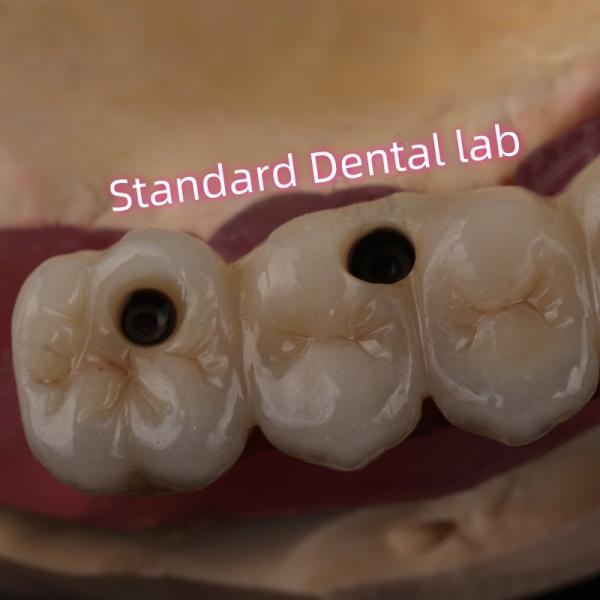 Fast Cement and Save Time Implant Products Dental Zirconia Crowns Bridge