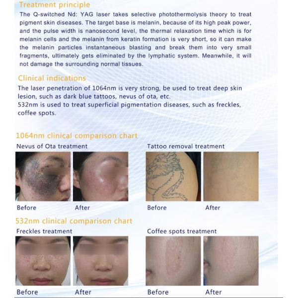 FDA TGA Medical CE approved Q switch nd yag laser for sale