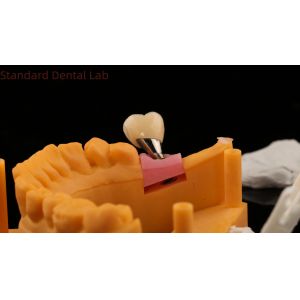 Dental Implant Screw Retained Crown PFZ Porcelain Layered Zirconia With 3D Print