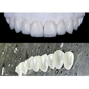 Quality IPS emax Press Porcelain Veneers Achieve a Natural and Radiant Smile for sale