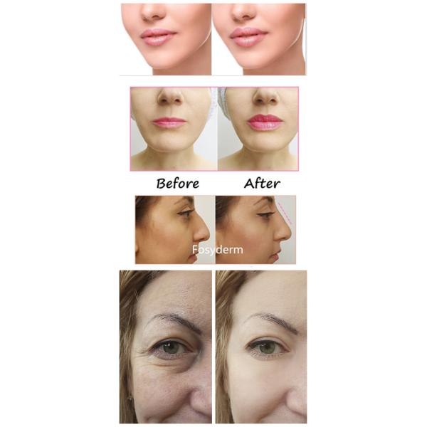 Fosyderm Hyaluronic Acid Lip Fillers Skin Care Product For Hyaluron Pen Use