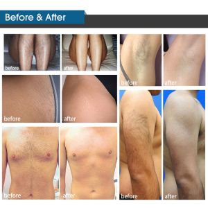 Portable 808nm Diode Laser Ipl Hair Removal Machine with Touch Screen