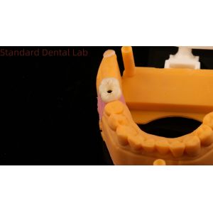 Dental Implant Screw Retained Crown PFZ Porcelain Layered Zirconia With 3D Print