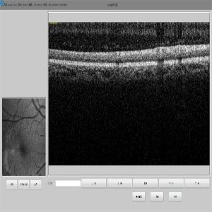 Retina OCT Scan Machine Non Invasive Ophthalmological Diagnosis