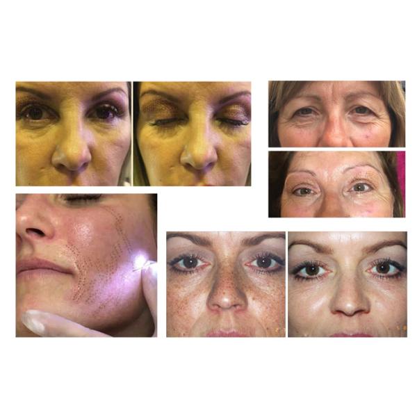 Remove Completely Multifunctional Beauty Machine Plasma Pen For Clinical