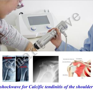 Osteoprosis Rehabiitation Heel Synovitis Extracorporeal Shock Wave Therapy