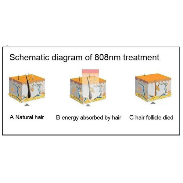 MED - 808 peak power 2000w net weight 43kgs portable diode laser hair removal painfree machine