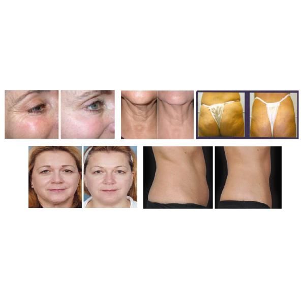 Slimming Body Vacuum Ultra Extra Cavitation RF Equipment