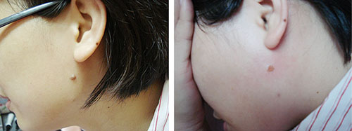 CO2 Fractional Laser Beauty Equipment for Remove Mole & Skin Cutting