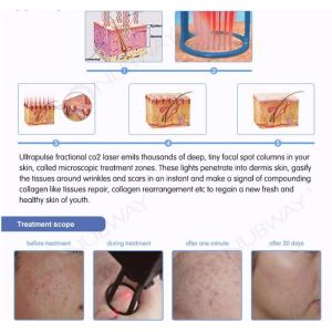 Stationary Fractional Laser Co2 Machine Scar Removal Infrared Skin