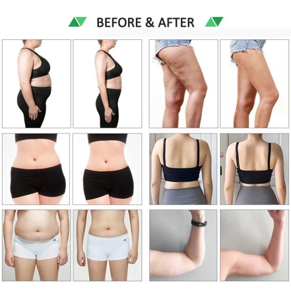 980nm Laser Liposuction Machine Portable Diode Laser for Vascular Removal