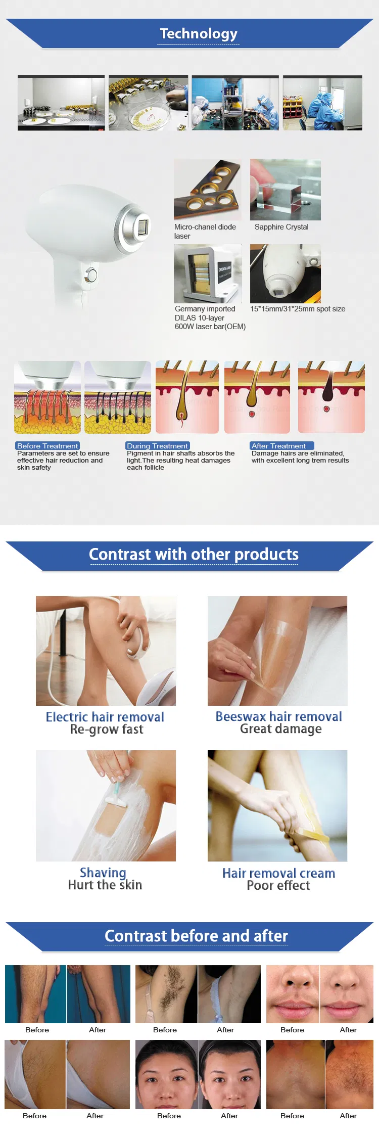 Fprofessional Sopra Device Beauty Equipment 808nm Diode Laser Hair Removal