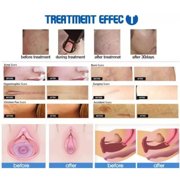 Medical Fractional Laser Beauty Machine System Control 10600nm Wavelength fractional co2 laser