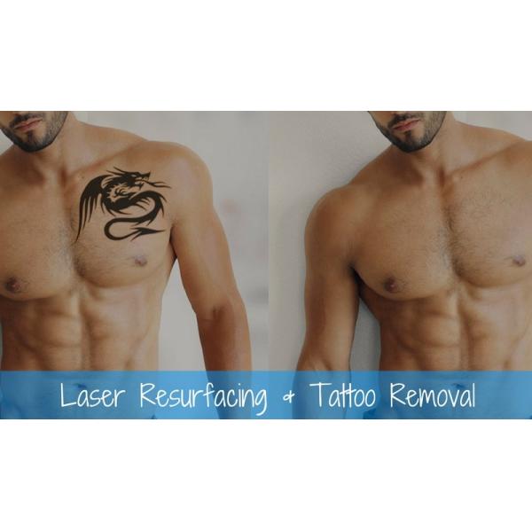 1000J Maximal Energy ND Yag Laser Tattoo Removal Machine With Honeycomb Tip