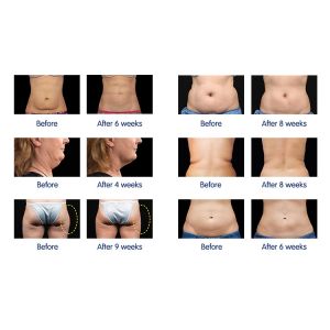 5 In 1 3D Cavitation Slimming Machine Ultrasonic Vacuum RF Photon Fat Burning