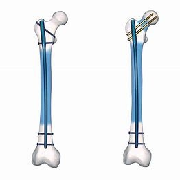 Buy Precice Ti Alloy Surgery Interlocking Nail Femur Mechanical Stable at wholesale prices