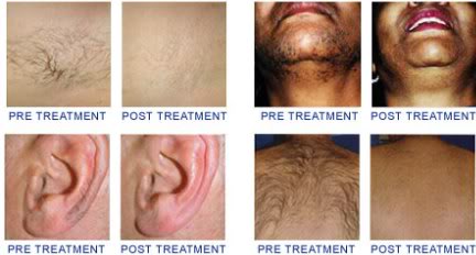 Factory directly selling newest 808nm diode laser hair removal machine in best price