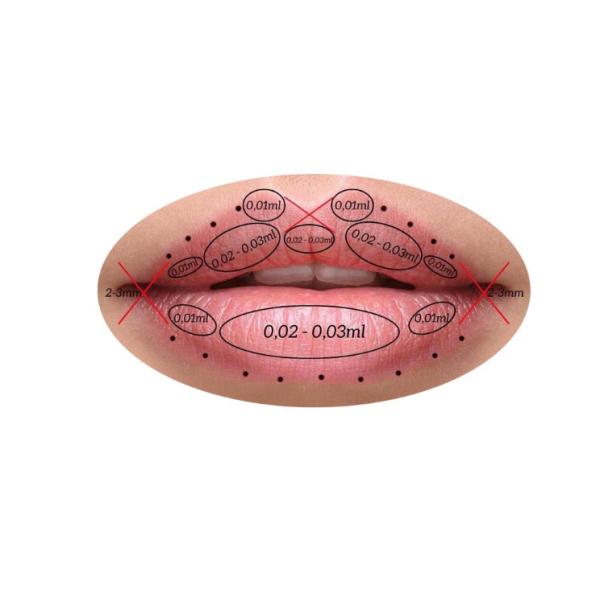 1.1ml Hyaluronic Acid Dermal Filler Lip Augmentation With Lidocaine