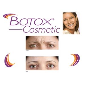 100 Unit Allergan Injection Anti Wrinkles For Face