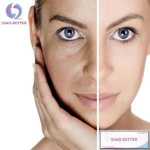 Safety Injectable Lip Wrinkle Filler Non Surgical Lip Augmentation