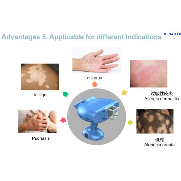 XeCl 308NM Excimer System Light Wavelength For Treating Skin Vitiligo Psoriasis Diseases