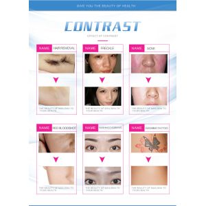 Factory Multi Function 4 in 1 Elight IPL RF Nd Yag Laser Hair Removal Tattoo