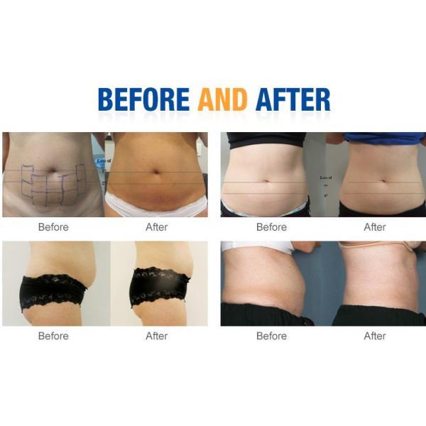 Non - Surgical Safe Liposonix HIFU Beauty Machine For Body Slimming / Skin Tightenin