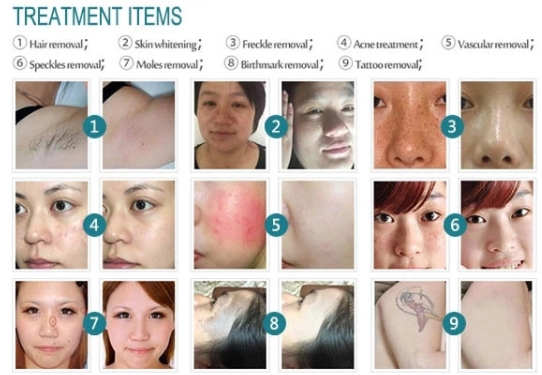 640nm 755nm IPL Hair Removal Machine For Full Body Skin Clean