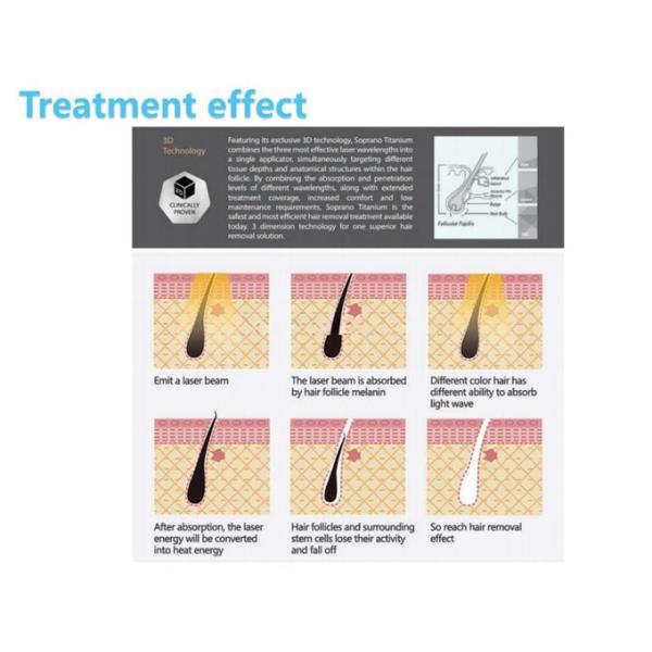 Fast and Efficient Diode Laser Hair Removal Machine for Men and Women 2