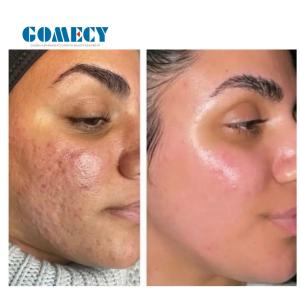 Morpheus 8 Microneedle RF Machine Wrinkle Removal ISO Certified