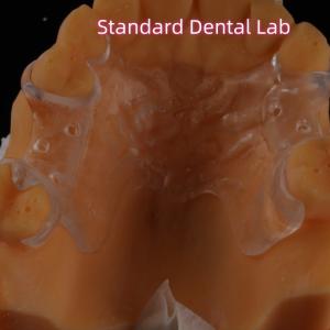 Removable Clear Acrylic Partial Denture Clasps Retentive Natural Looking