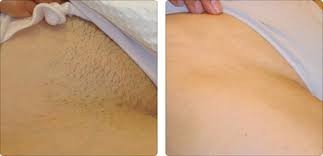 Buy high performance diode laser hair removal price at wholesale prices