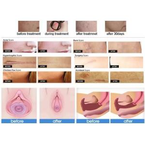 ISO Lasertell 10.4 Inch Screen Co2 Fractional Laser Equipment