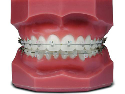 Comfortable Fixed Orthodontic Appliances Beautiful Natural Ceramic Brackets